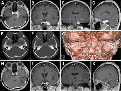 Hybrid endoscopic-microscopic surgery for dumbbell-shaped trigeminal schwannoma: case report and literature review